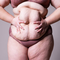 Woman holding excess stomach skin.