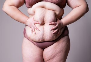 Woman holding excess stomach skin.
